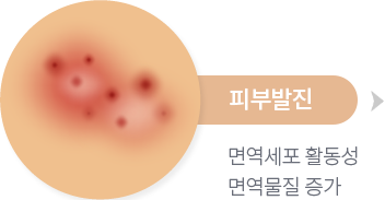 피부발진, 면역세포 활동성 면역물질 증가