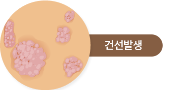 건선발생