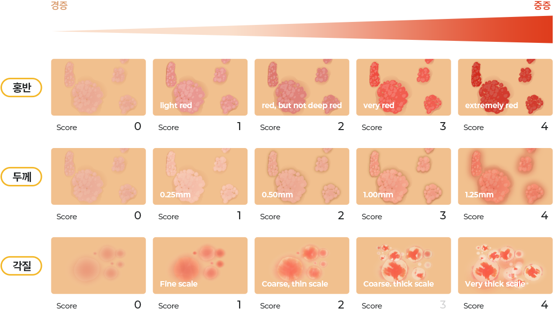홍반 두께 각질의 변화 이미지