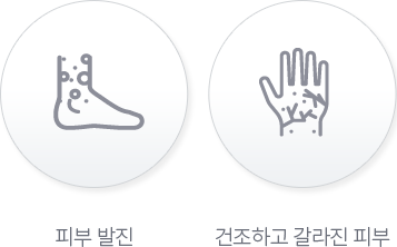 건선에 걸린 발과 손모습, 피부발진, 건조하고 갈라진 피부