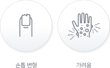 변형된 손톱모양과 가려운 손모양